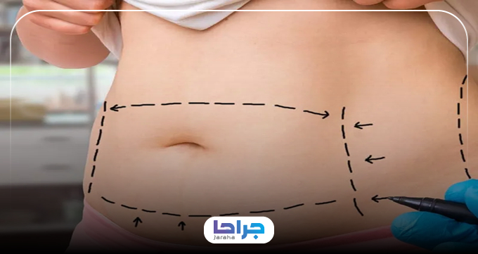 چگونه بهترین جراح لیپوماتیک خانم در تهران را پیدا کنیم؟