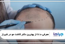 بهترین دکتر کاشت مو در شیراز