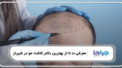 بهترین دکتر کاشت مو در شیراز