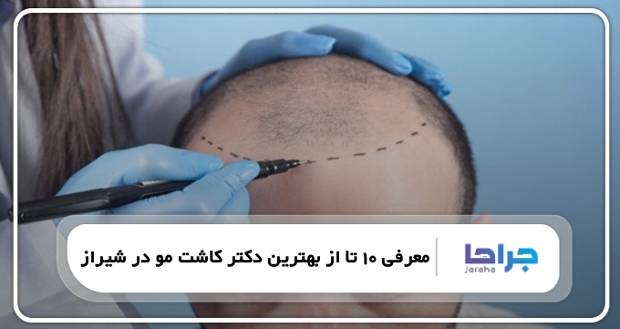 بهترین دکتر کاشت مو در شیراز