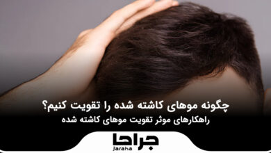 چگونه موهای کاشته شده را تقویت کنیم؟