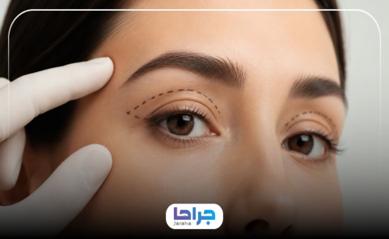 نکات مهم پس از بلفاروپلاستی