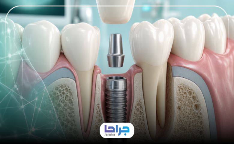 دوره نقاهت ایمپلنت دندان