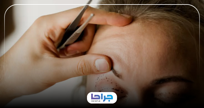 انجام جراحی بلفاروپلاستی در اصفهان برای رفع افتادگی و پف پلک