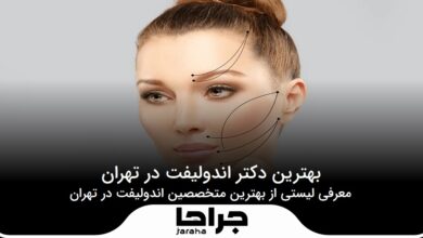 بهترین دکتر اندولیفت در تهران