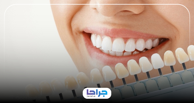 روش های شناخت بهترین دکتر بلیچینگ در تهران