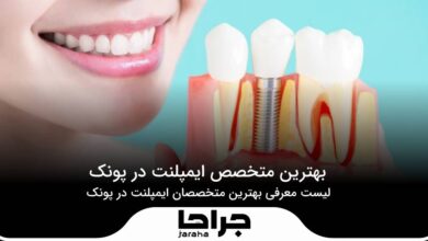 بهترین متخصص ایمپلنت در پونک