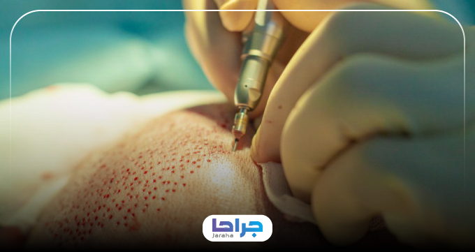 بانک موی مناسب برای کاشت مو چه ویژگیهایی دارد؟