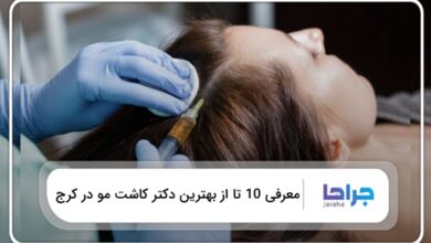 بهترین دکتر کاشت مو در کرج