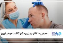 بهترین دکتر کاشت مو در تبریز