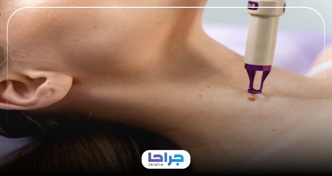 ویژگیهای برترین مراکز برداشتن خال در تهران