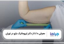 بهترین دکتر لیپوماتیک بازو در تهران