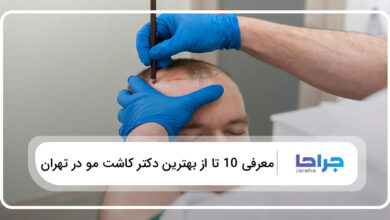 بهترین دکتر کاشت مو در تهران