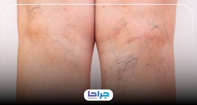 هزینه خدمات بهترین دکتر واریس در کرج