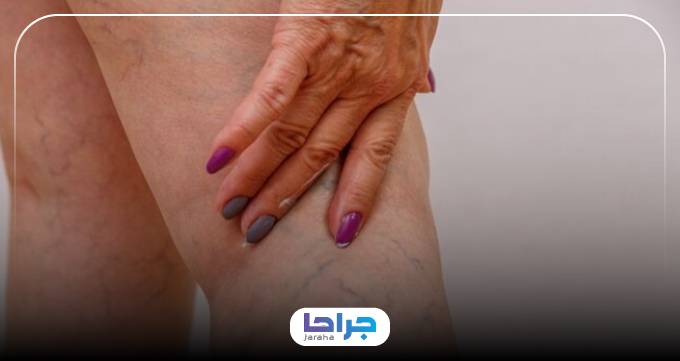 هزینه خدمات درمانی بهترین دکتر واریس پا در ایران