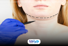 بهترین دکتر ساکشن غبغب در یافت آباد