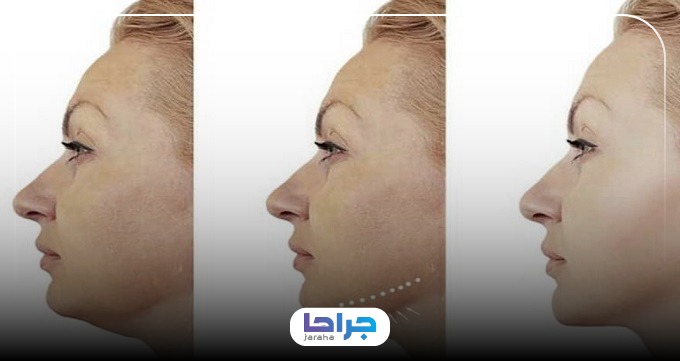 ساکشن غبغب چه تفاوتی با بوکال فت دارد؟