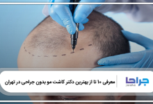 بهترین دکتر کاشت مو بدون جراحی در تهران