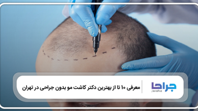بهترین دکتر کاشت مو بدون جراحی در تهران
