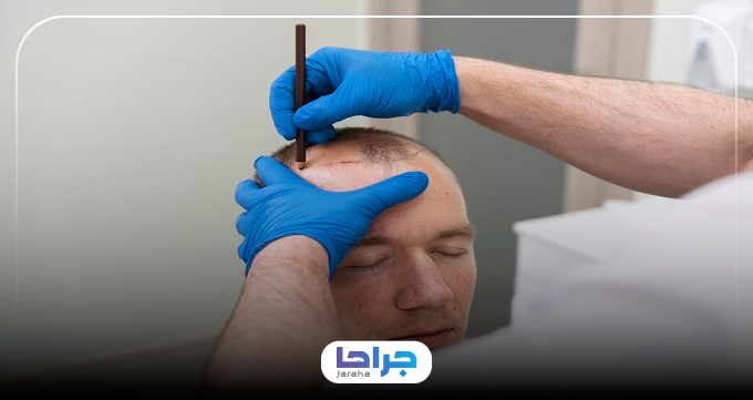 بهترین روشهای کاشت مو بدون جراحی را بشناسید!