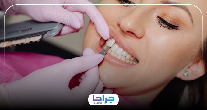 آشنایی با انواع برندهای معتبر لمینت دندان