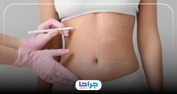 بعد از ابدومینوپلاستی چه مراقبتهایی لازم است؟
