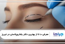 بهترین دکتر بلفاروپلاستی در تبریز