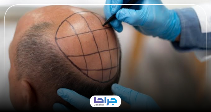 چگونه دکتر کاشت مو قابل اعتماد در ولیعصر پیدا کنیم؟