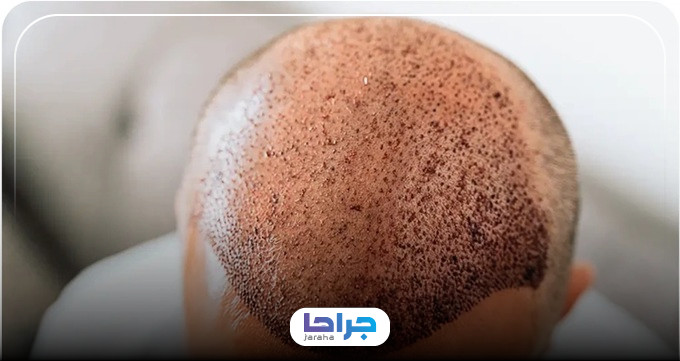 ویژگیهای بهترین دکتر کاشت مو در زعفرانیه