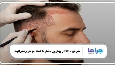 بهترین دکتر کاشت مو در زعفرانیه