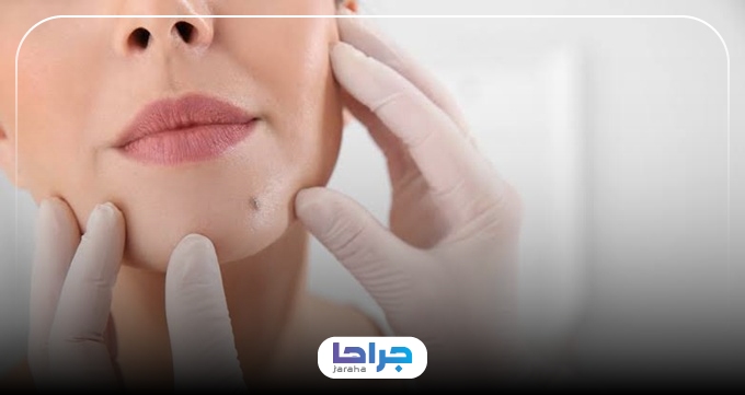 چرا انتخاب بهترین مرکز برای خال برداری اهمیت دارد؟