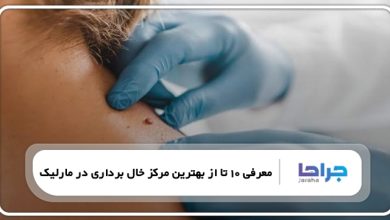 بهترین مرکز خال برداری در مارلیک