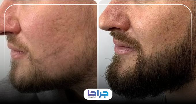 عوارض احتمالی کاشت ریش و سبیل