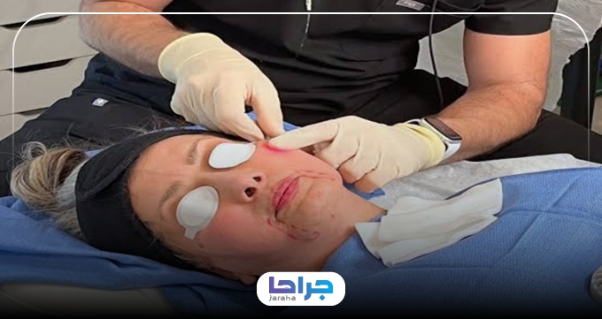 نحوه انجام اندولیفت غبغب