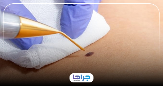 نکات طلایی برای انتخاب امنترین مرکز برداشتن خال در صباشهر