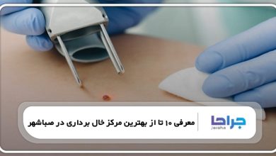 بهترین مرکز خال برداری در صباشهر