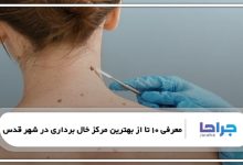بهترین مرکز خال برداری در شهر قدس