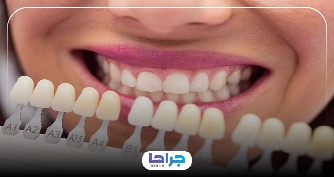 کامپوزیت دندان برای چه کسانی مناسب است؟