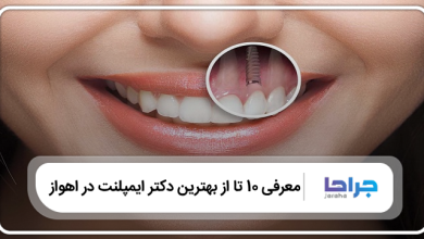 بهترین دکتر ایمپلنت در اهواز