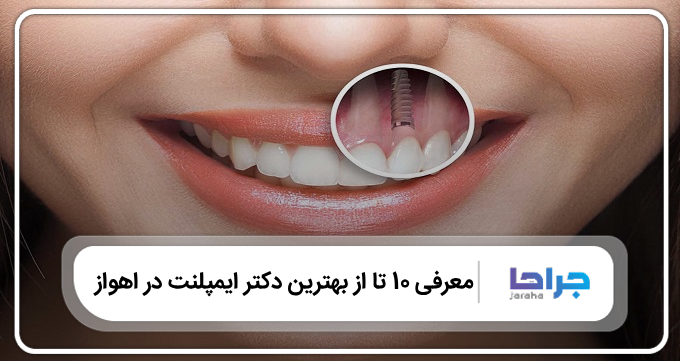 بهترین دکتر ایمپلنت در اهواز