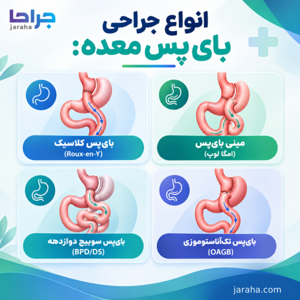 انئاع جراحی بای پس معده